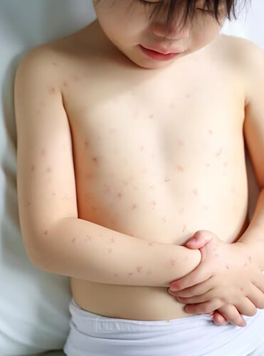 Symptoms of Common Skin Conditions in Children