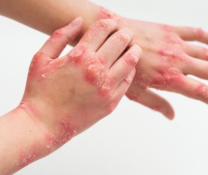 hands-patient-suffering-from-psoriasis (2) (1)